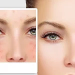 home remedies for scars