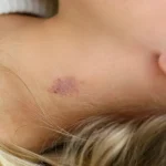 How to get rid of Hickeys