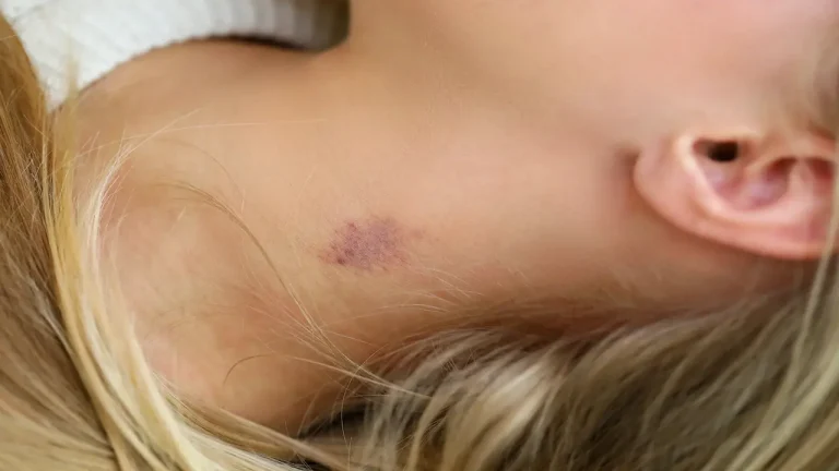 How to Get Rid of Hickeys?