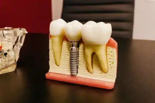 advantages of dental implants