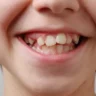misaligned teeth and jaw