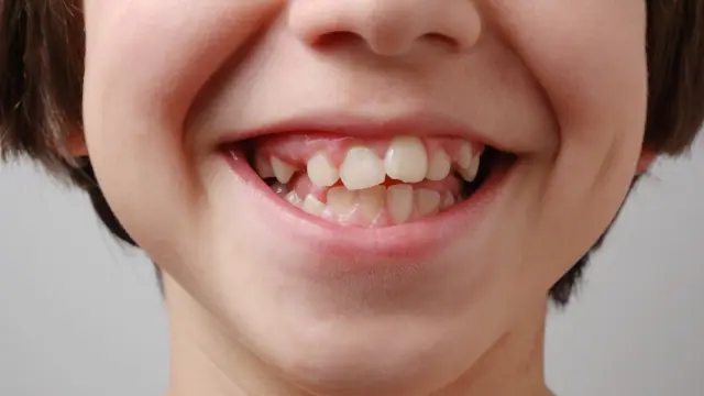 misaligned teeth and jaw